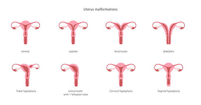 Human uterine malformations. Set of medical charts.
