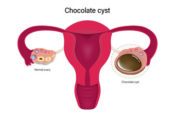 Chocolate cyst. Female ovarian disease vector. Ovarian cyst with female reproductive system. - obrazy, fototapety, plakaty