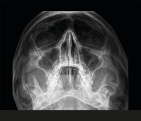 Face x-ray. Radiography below view of a womans face