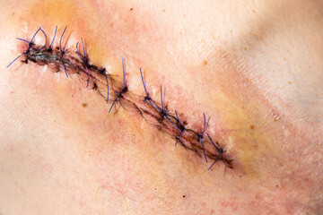 Suture wound after fracture of the right clavicle after surgery, close up image