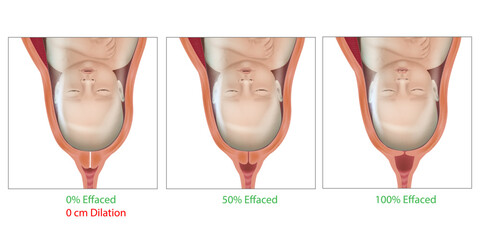 Cervical Effacement and Dilation During Delivery. Cervix, Labor or delivery. Cervix changes from not effaced and dilated to fully effaced and totally. Effaced 0, 50,100 - obrazy, fototapety, plakaty
