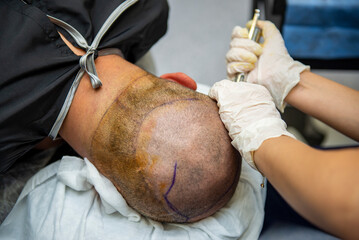 Hair Transplant Recovery - obrazy, fototapety, plakaty