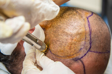 Hair Transplant Recovery