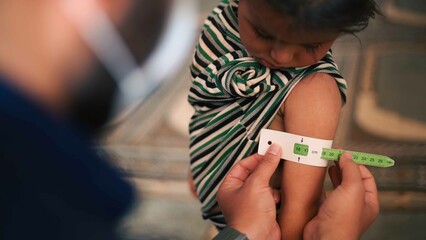 A doctor examines children's malnutrition inside a refugee camp. Malnutrition was measured using a mid-upper arm circumference belt.  - obrazy, fototapety, plakaty