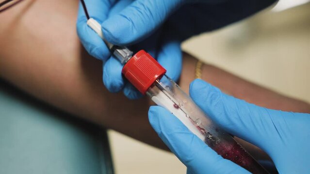 close up view of Lab Worker hands Extracts blood from vein. a stream of blood flows into the test tube