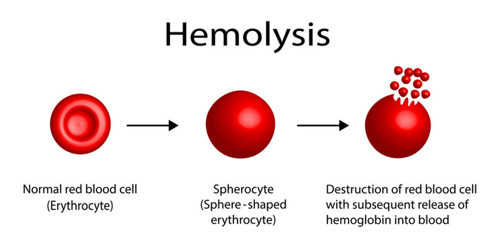 Hemolysis. Normal red blood cell, spherocyte, then destruction of red blood cell with subsequent release of hemoglobin into blood. Vector illustration