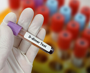 Obraz premium Lab Technologist holds blood sample for D dimer test. Corona patient monitoring test with laboratory background.