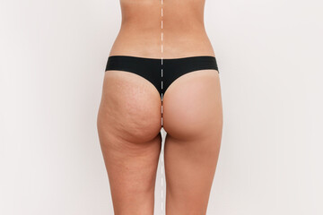 Young woman's thighs and buttocks with cellulite before and after treatment isolated on white background. Getting rid of excess weight. Result of diet, sports. Improving the skin on legs - obrazy, fototapety, plakaty