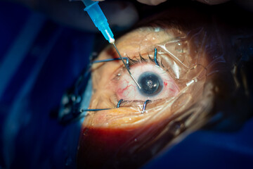 Phacoemulsification, destruction of the opaque lens by ultrasound, ophthalmic eye surgery. eye lens replacement, intraocular lens installation, surgical cataract treatment. 