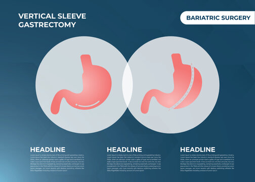 Laparoscopic Sleeve Gastrectomy, Vertical Gastrectomy, Weight Loss Surgery Vector Illustration Of Stomach Reduction Surgery
