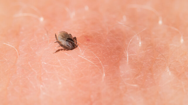Parasitic deer tick bitten in human skin at sucking blood. Ixodes ricinus or scapularis. Closeup of dangerous insect mite on pink background of epidermis with light hairs. Tick-borne diseases carrier.