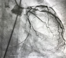 Coronary angiography shown left main (LM) stenosis with triple vessel disease (TVD).