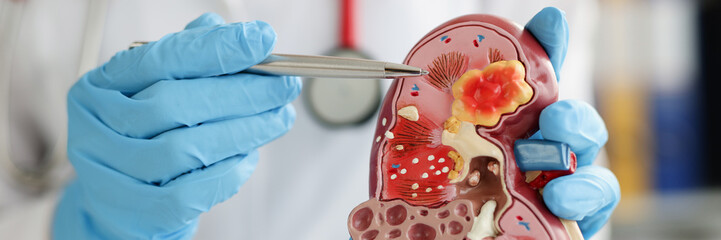 Urologist pointing pen kidney structure on anatomical model