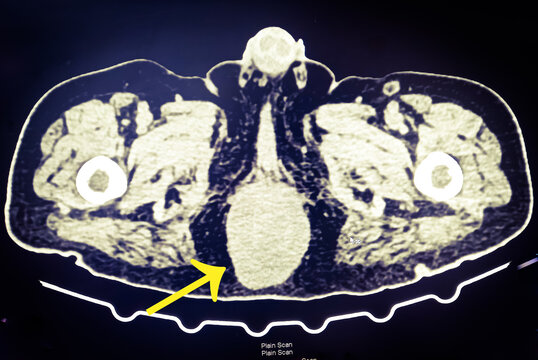 CT scan image of preanal or rectum abnormal growth, diagnosis Colon cancer and colorectal cancer. Computer image.