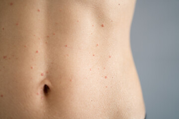 Woman Body Skin With Red Allergy Eruption