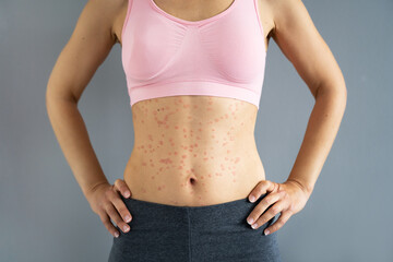 Body Skin With Psoriasis Autoimmune Disease