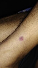 A blood cloting spot on the skin, red color, 