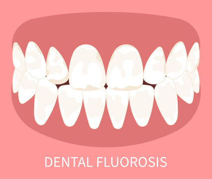 Dental Fluorosis Teeth Discolored Pitted Grooved Turner's Hypoplasia