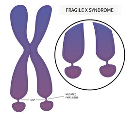 DNA disorder testing of Fragile x syndrome with ADHD and for elongated face flat feet protruding ears inherited health depression forehead disability prominent jaw