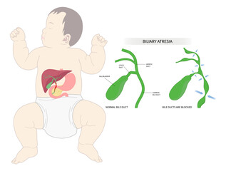 fatal enlarged spleen infection Biliary atresia bile duct blocked Primary acute choledochal cyst stone obstructive damage bilirubin level acid test scan ascites yellowing skin Acholic stool liver pain