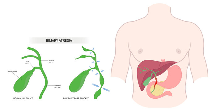 acute infection bile duct blocked Choledochal cyst obstructive fatal enlarged spleen Biliary atresia Primary stone damage bilirubin level acid test scan ascites yellowing skin Acholic stool liver pain