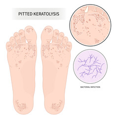 pitted keratolysis athlete's foot fungal heel wet cold skin  toe bacteria poor foul odor itchiness Sweat small hole footwear Basal cell rash Focal acral hyperkeratosis sore warts deep