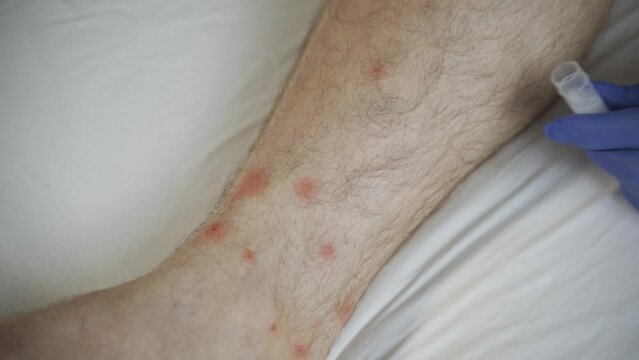 The doctor diagnoses Dry skin, Psoriasis of the feet. The skin is damaged. Dermatitis, eczema, psoriasis, allergic reaction. Close-up - peeling and cracking on the foot of a person. Fungal infection