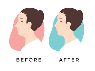 Woman profile. Female face before and after receiving hardware cosmetology procedure. Double chin. Woman face. Vector illustration