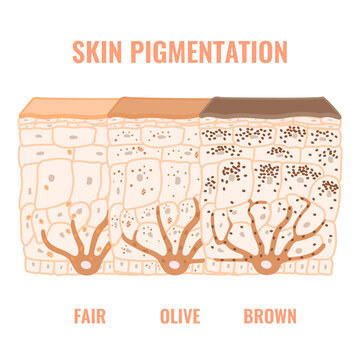 Melanin content and distribution in different skin tone phototypes. Pigmentation mechanism in dark, olive and light skin. Epidermis cross-section infographic medical diagram. Vector illustration.