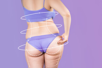 Buttocks, hip, back liposuction, fat and cellulite removal concept, overweight female body with...