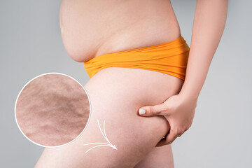 Obesity female legs with cellulite, fat thighs and buttocks with an enlarged area of skin