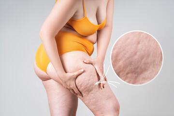 Obesity female legs with cellulite, fat thighs and buttocks with an enlarged area of skin