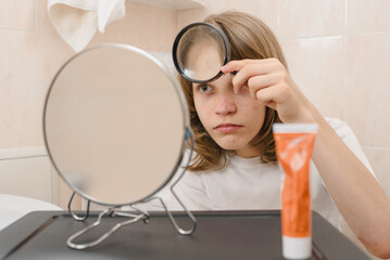 Young boy holding magnifying glass and examining the acne skin