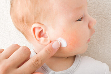 Fototapeta Young adult mother finger applying white medical ointment on newborn boy cheek. Red rash on skin. Allergy from milk formula or mother milk. Care about baby body. Closeup. Top down view. obraz