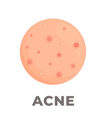 The consequences of poor skin care. Vector illustration of inflamed pimples on the skin. Acne. Dermatological disease. 