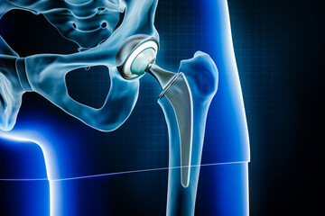 Femoral head hip prosthesis or implant. Total hip joint replacement surgery or arthroplasty 3D rendering illustration. Medical and healthcare, arthritis, pathology, science, osteology concepts. - obrazy, fototapety, plakaty