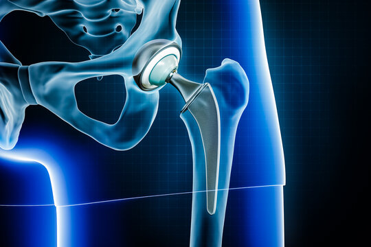 Femoral head hip prosthesis or implant. Total hip joint replacement surgery or arthroplasty 3D rendering illustration. Medical and healthcare, arthritis, pathology, science, osteology concepts.