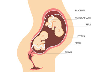 Double pregnancy. Anatomy of the uterus with twin fetuses. Placement of dizygotic twins. flat illustration