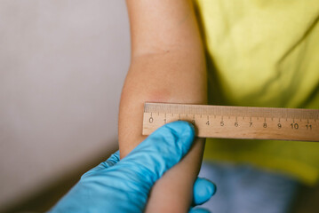 Tuberculin test on the child's arm. Analysis, inspection of the vaccination.