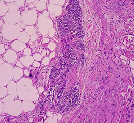 Prepatellar region histology: Chronic bursitis. light microscopic image show soft tissue, tissue...