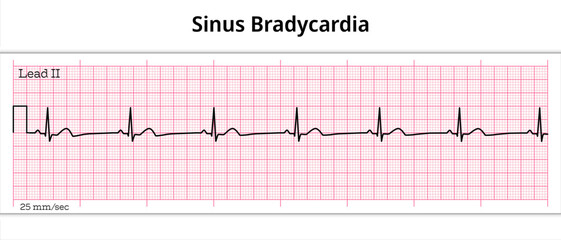 ECG Sinus Bradycardia - 8 Second ECG Paper