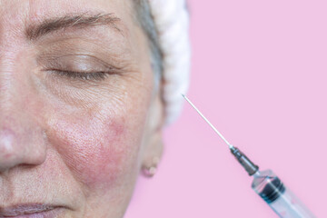 elder senior gray hair grandmother woman rosacea problematic skin use syringe with solution anti...