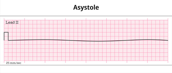 ECG Asystole - 8 Second ECG Paper
