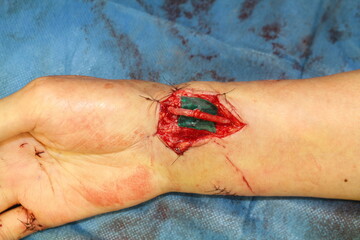 Obraz premium vascular graft
