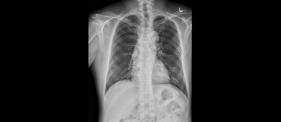 Chest x-ray image demonstrated heart, lungs, ribs, bones and muscles.Metastatic cancer or primary...