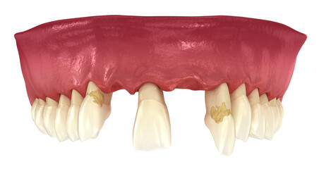 Periodontitis, gum recession and lost teeth. Medically accurate 3D illustration - obrazy, fototapety, plakaty