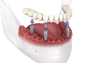 Dental rosthesis based on 4 implants. Dental 3D illustration