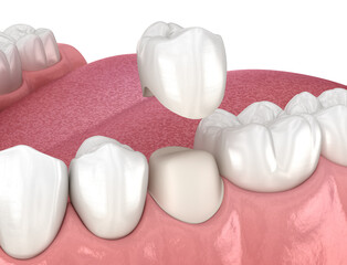 Preparated premolar tooth and dental crown placement. Medically accurate 3D illustration