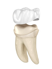 Porcelain crown placement over molar tooth. Medically accurate 3D illustration