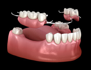 Removable partial denture, mandibular prosthesis. Medically accurate 3D illustration of prosthodontics concept - 544543076